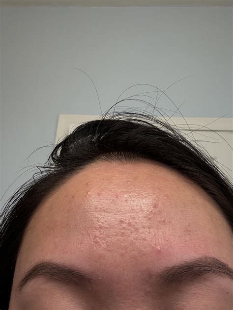 Forehead bumps [acne] : r/SkincareAddiction