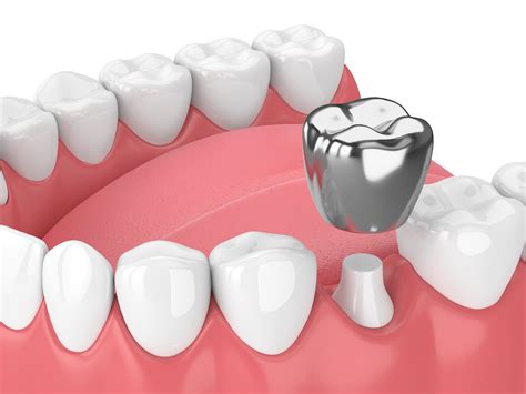 The Different Types Of Dental Crowns And When To Use Them - Erio Syce