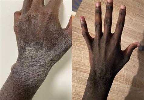 More progress with strict keto/lion diet for extreme eczema & Topical Steroid Withdrawal : r/SebDerm - diet of lion