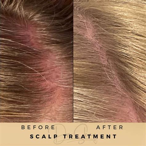 Scalp Eczema Treatment Dr Sknn | Scalp Eczema Remedies