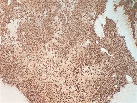 Case 1111 - Man in his 50s with Periodic Sweating and Diarrhea | Department of Pathology
