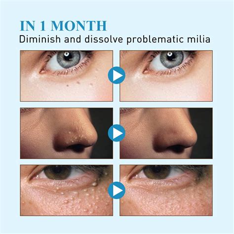 How Can I Remove Milia