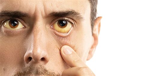 Yellow Eyes: Causes, Symptoms, and Treatment - INSCMagazine