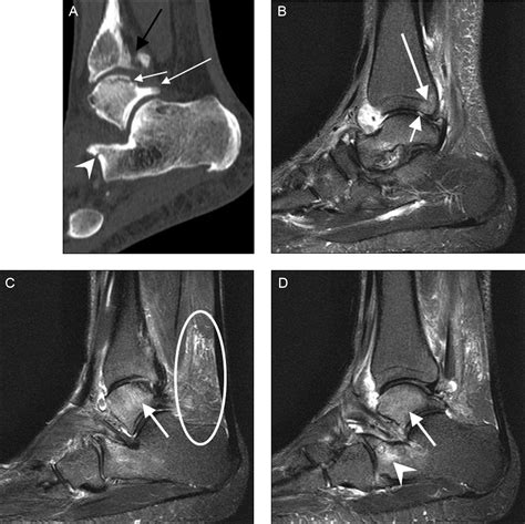 Posterior ankle impingement in athletes: Pathogenesis, imaging features ...
