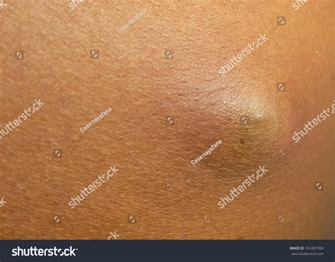 450 Sebaceous Cyst Bilder, Stockfotos und Vektorgrafiken | Shutterstock