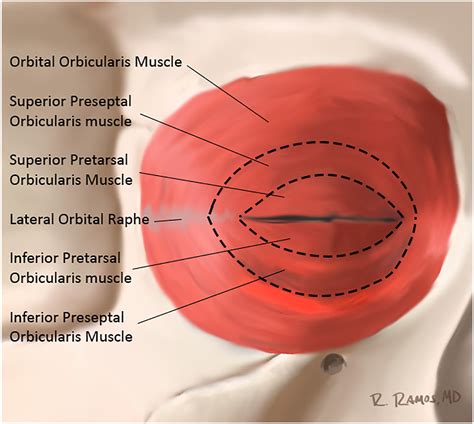 Applied Anatomy of the Lower Eyelid - Clinics in Plastic Surgery