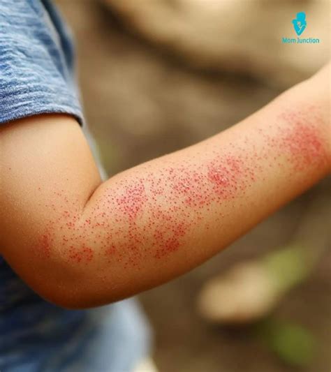 Skin Rashes In Children Viral Rash Baby: Pictures, Types, And