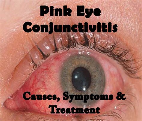 Understanding Pink Eye Conjunctivitis - Causes and Treatment