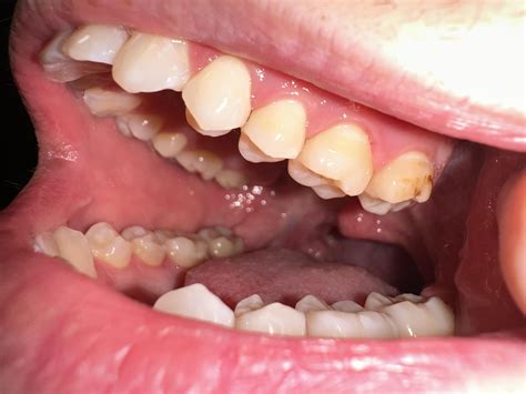 What are these brown spots on my molars and how bad are they? : r/askdentists