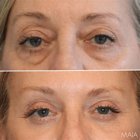 Brow Lift | Maia Plastic Surgery