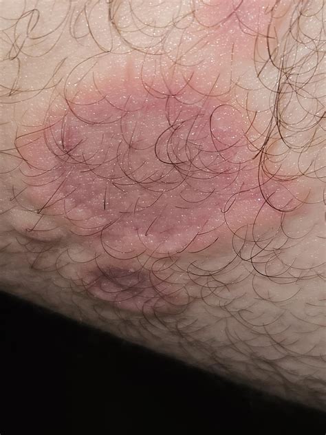 Rash On Inner Thigh