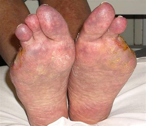 Purple Toe Syndrome - EJVES Extra