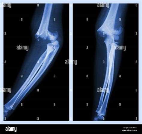 Fracture elbow (Left image : side position , Right image : front position Stock Photo - Alamy