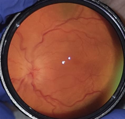 Review of Ophthalmology on Twitter: "April 2023 Wills Eye Resident Case ...