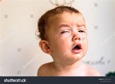 Eye Rheum In Infants