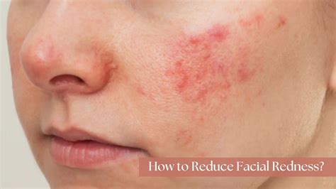 10 Causes You Have Skin Facial Redness & How to Reduce It