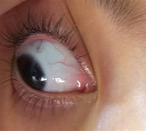 Black Spot In Eye Ball