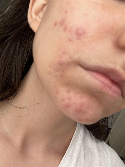 Cystic acne? Scars? Psoriasis/Eczema? : r/acne
