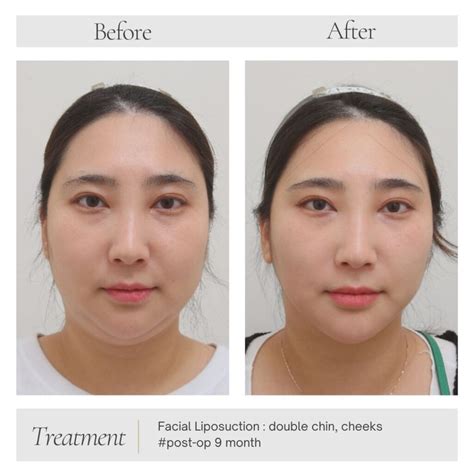 Considering Double Chin Surgery? Know Your 3 possible options - Fresh Clinic Seoul