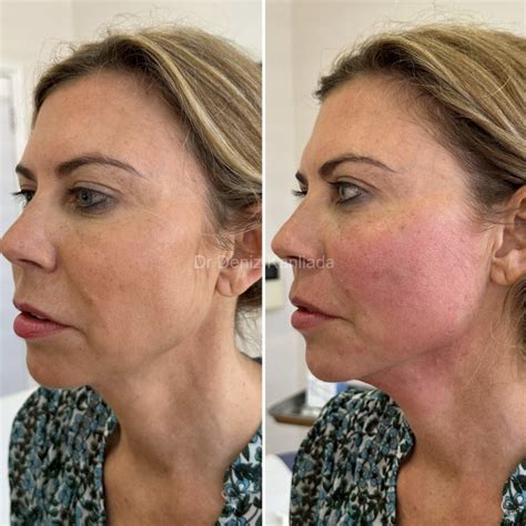 Endolift: Non-Surgical Face Lift - Derma Revive Skin Clinic