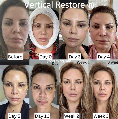 Vertical Restore Recovery Time San Diego | Dr. Karam | Facial plastic surgery, Best plastic ...