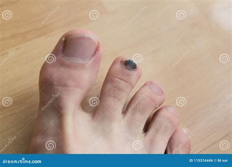 Nail Turning Black Without Injury