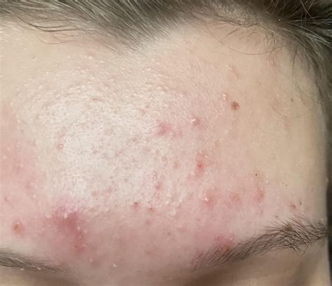 is this fungal acne? : r/Fungalacne