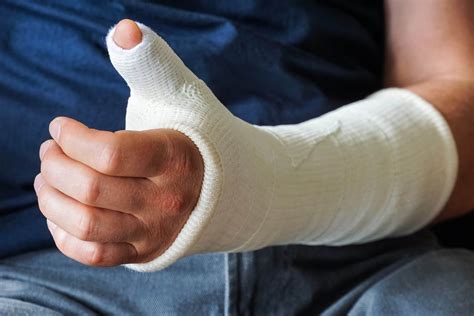 Split Cast Fracture at David Masterson blog