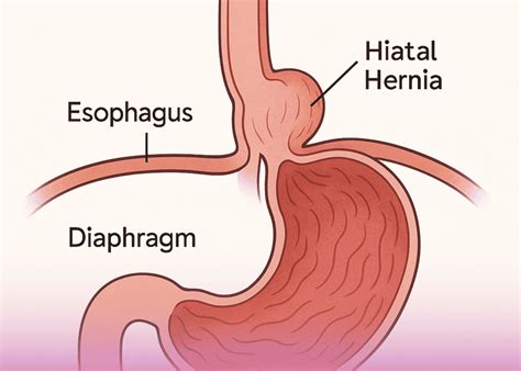 Hiatal Hernia: Causes & Surgical Treatment | Burjeel Medical City