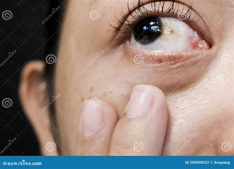 A Woman with Brown Spot on Her Eye Stock Photo - Image of hemorrhagic ...