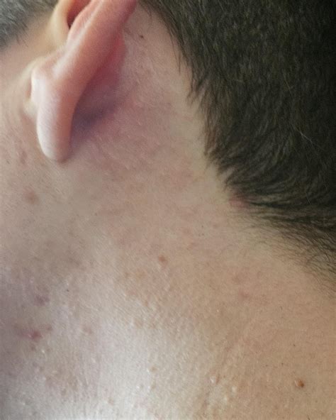 Tiny bumps behind ear : r/DermatologyQuestions