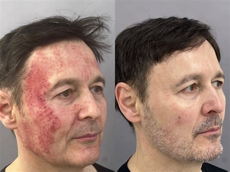 Rosacea Laser Treatment Bruising