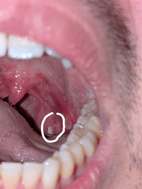 Ulcer On Tonsil Canker Sore Hi Res Stock Photography And Images