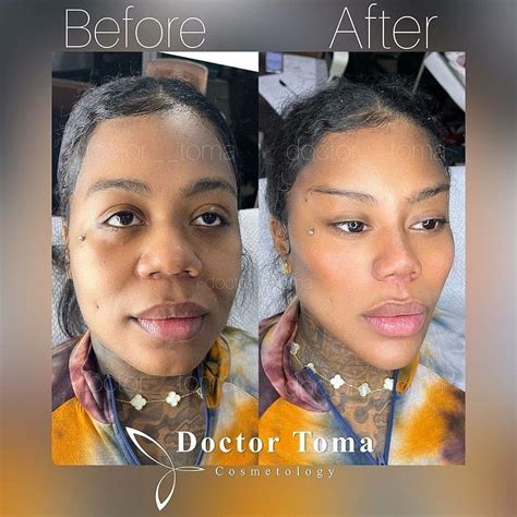 Pin by ..... on aaaah | Rhinoplasty nose jobs, Facial surgery, Facial contouring