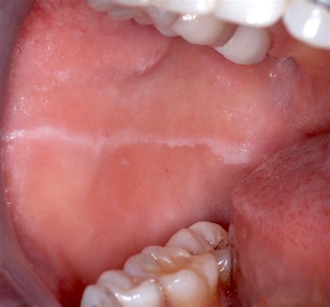 Linea Alba Cheek Biting