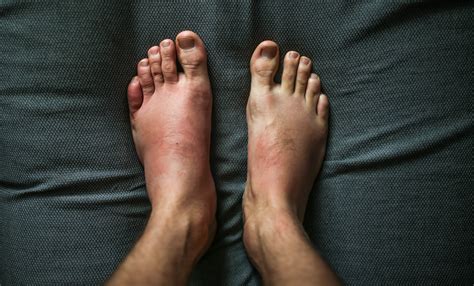 Psoriatic Arthritis Toes