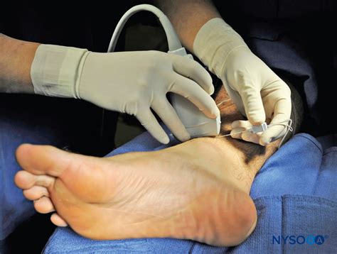 Regional Anesthesia Needle at Amber Girdlestone blog