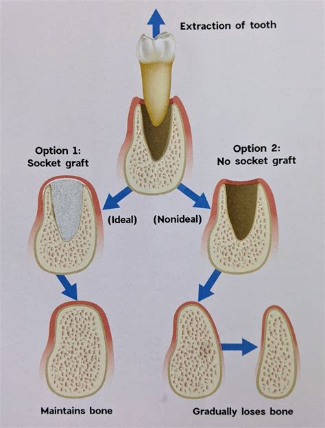 Bone Loss In Mouth