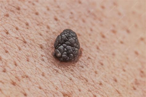 Premium Photo | Closeup of a dangerous brown nevus on human skin melanoma closeup of a ...