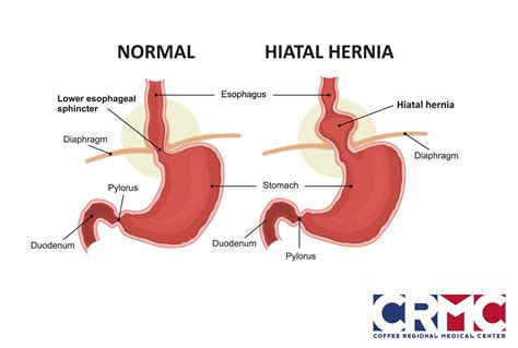 What Causes Hiatal Hernia