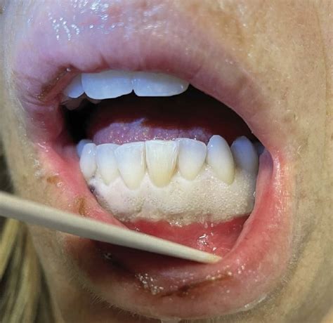 White Lines On Your Gums at Joel Nettleton blog