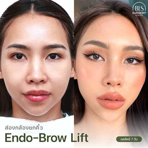 หมอบีม & หมอเอิร์ธ คว้ารางวัลเลิศ 'The Best Endoscopic Brow Lift