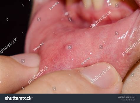Clear Bubble Under Tongue