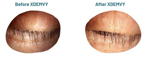 Xdemvy for Demodex: Solutions for Eyelid Issues - Precision Eye Care ...