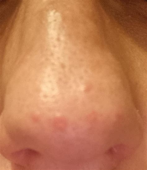 Red Spot On Nose