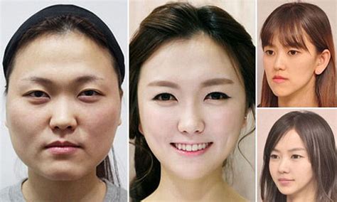 Korean Artist Plastic Surgery Before And After