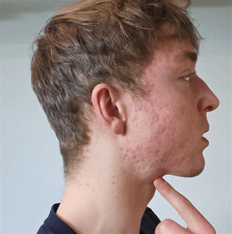What is causing this bump under my jawline? : r/Mewing