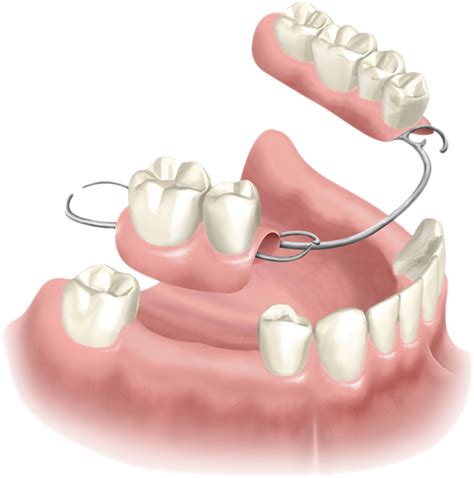 Mandibular Partial Denture