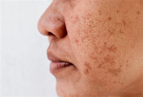 Mask Of Pregnancy Upper Lip