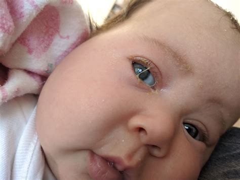 Baby Eye Discharge One Eye at Nathan Lozano blog